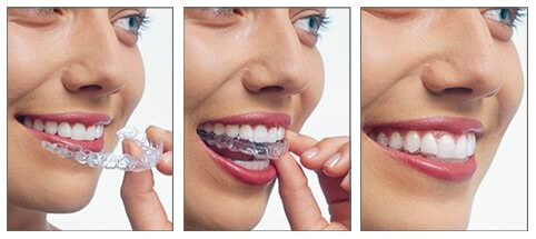 Invisalign avant / après : 3 exemples de traitements avec gouttières  transparentes réalisés au cabinet d'orthodontie à Paris