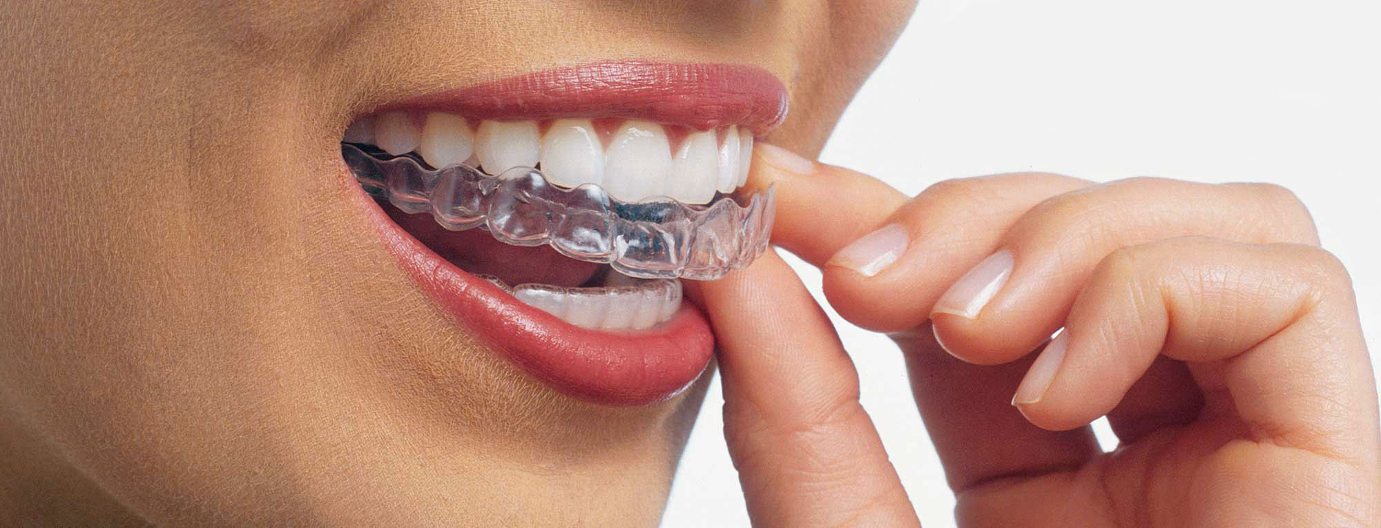 
Les appareils dentaires en orthodontie : guide complet du Dr Asselborn