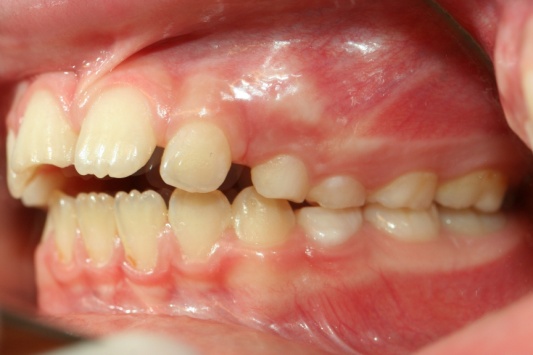 Dents déformées et sucette : tout savoir sur les effets de la tétine -  Dentiste pour Enfants